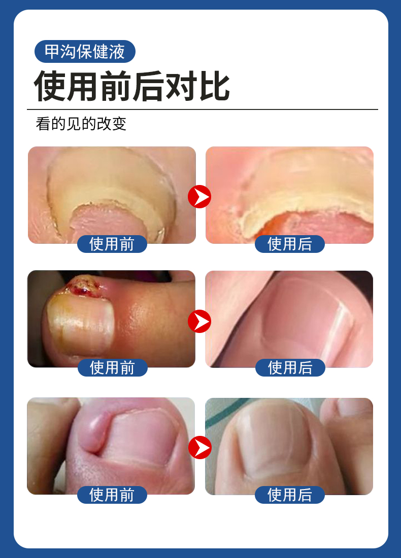 甲溝炎專用液有用嗎？使用前后對比